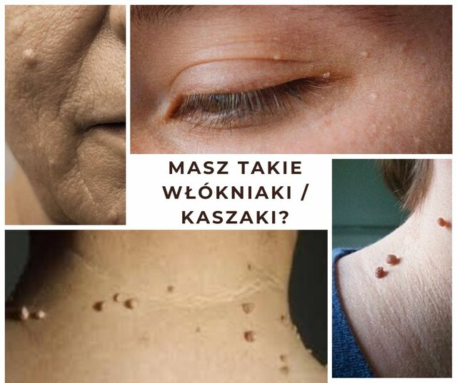 Masz takie włókniaki.jpg - SwingersBeautyWawa